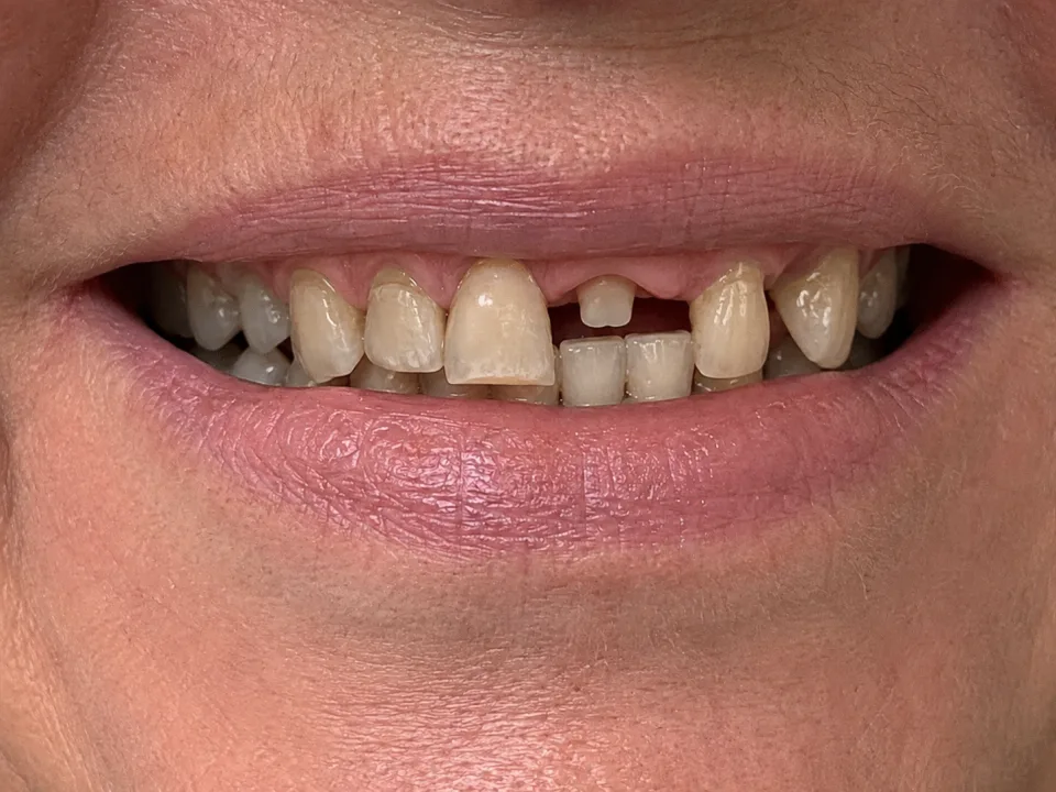 Illustrative example of a smile before treatment